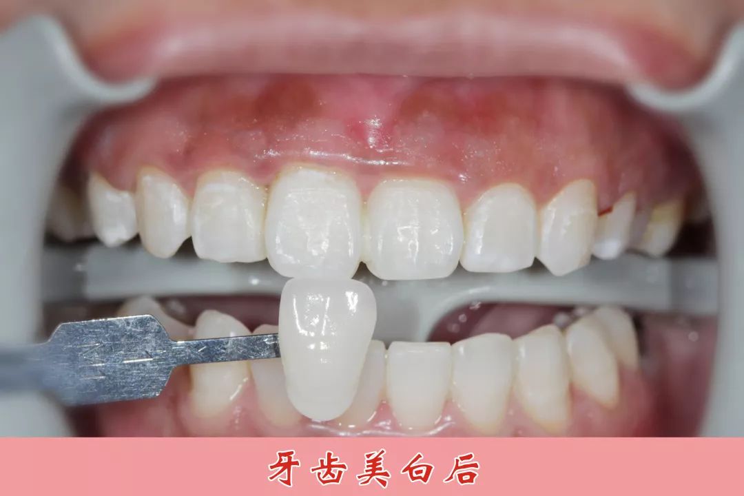 牙齿美白医院排名_医院冷光美白牙齿图片