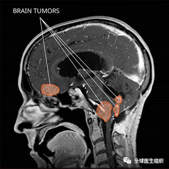 什么是基因突变的肿瘤 3e3dd954cc654cf1b8880af7b28dd3cb.jpeg