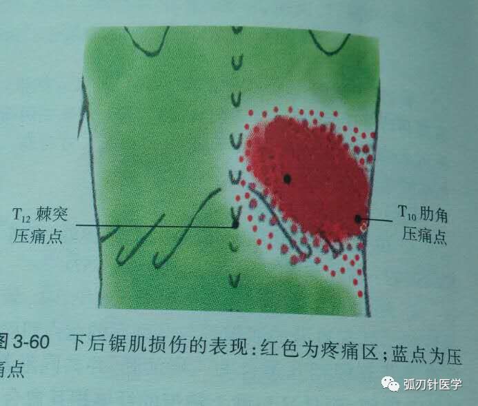 疼痛时发时止,不敢做肺活量大的工作或运动,慢性期痛点多在下后锯肌中