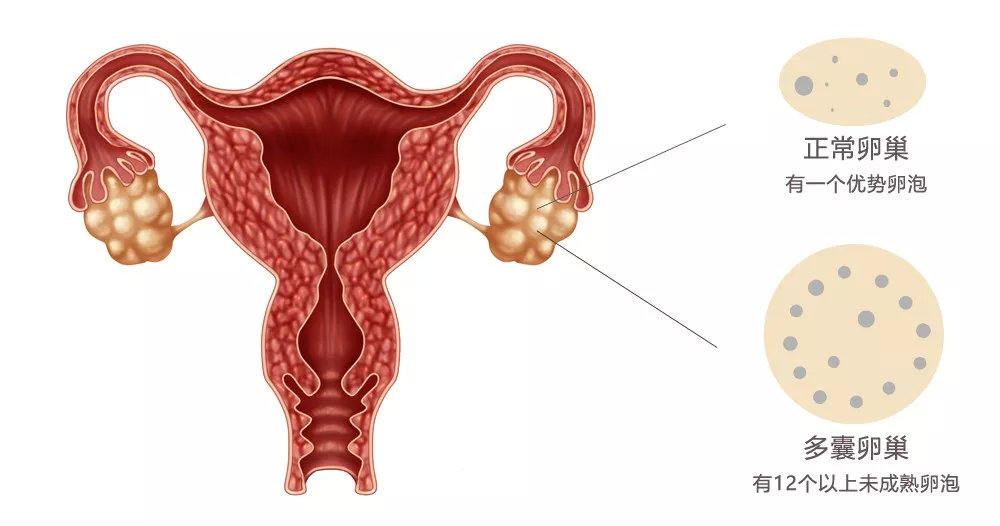 多囊人口渴_多囊卵巢的人不容易老