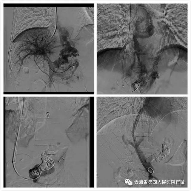 青海省第四人民医院介入科成功实施首例经皮经颈静脉肝内门-体静脉