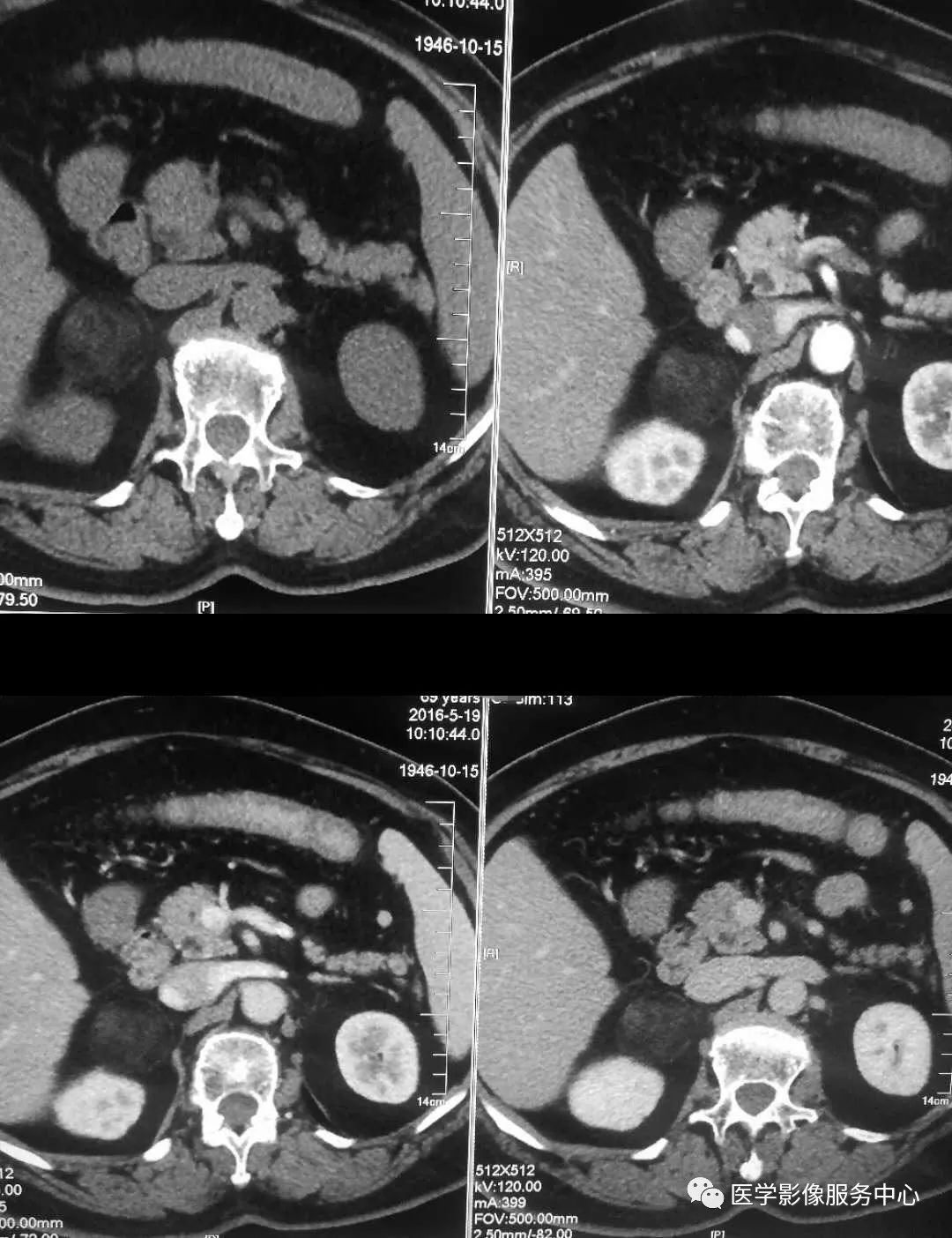 ct平扫 增强病史:患者,女,69岁,体检发现"肾上腺占位;【医学影像服务