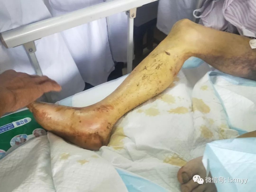 张家界一老农遭五步蛇连咬五口……