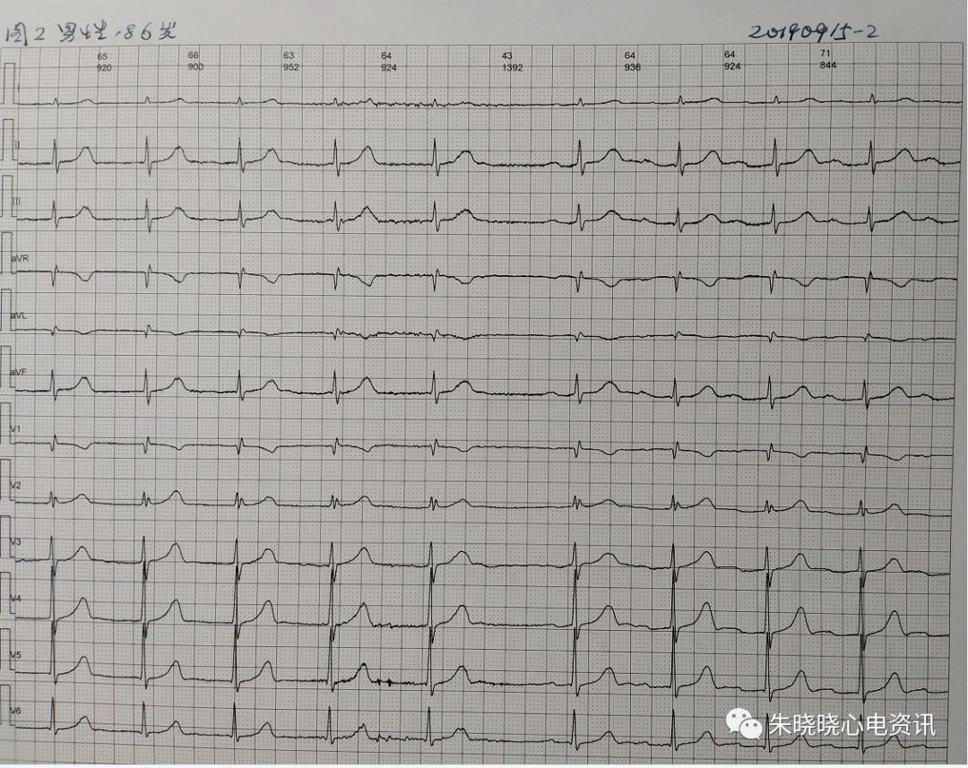 卢老师看心电图-- 酷似交界性心律的窦性心律合并一度