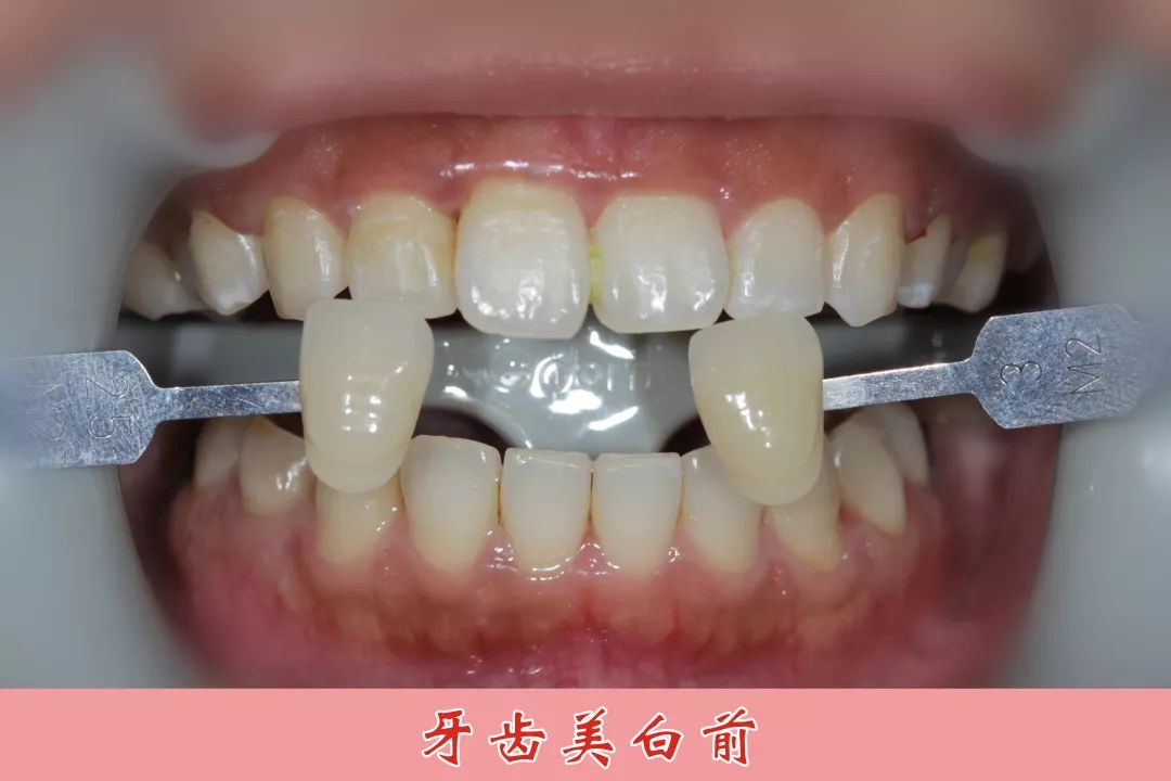 牙齿美白医院排名_医院冷光美白牙齿图片(3)