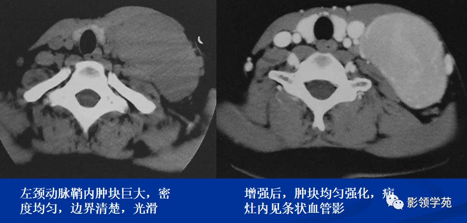 颈部肿块的特点