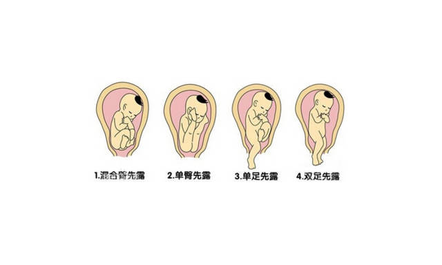 复合位:胎先露部伴有肢体同时进入骨盆入口,称复合位.