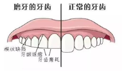 牙齿健康的 磨牙 磨牙在生活中非常常见 部分小朋友会在发育期磨牙齿
