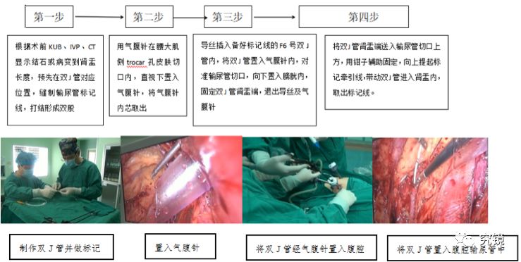 手术操作过程图示术后效果评价双j管置入后kub:双j管位置正确,引流
