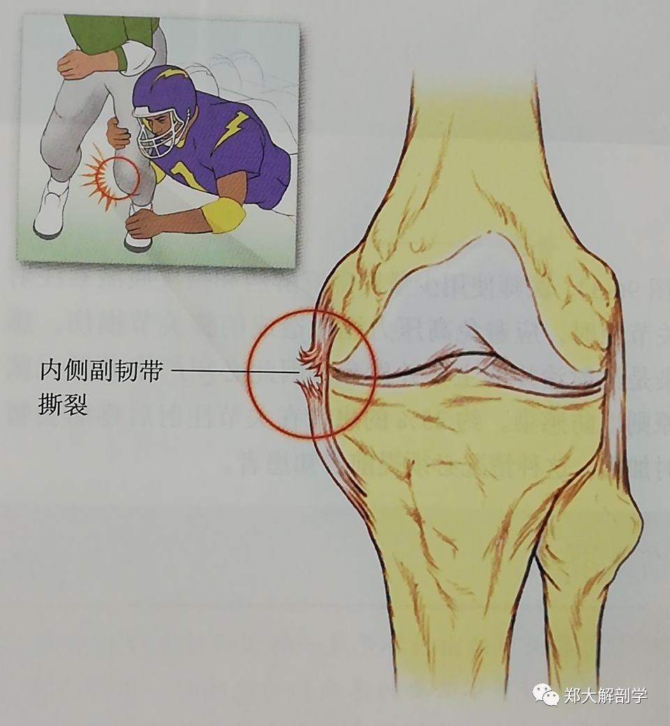 内侧副韧带综合征的特点是在膝关节内侧的疼痛.