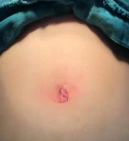 手术后刀口会留疤吗 1ed2844142b14103bff912ec631ff1cf.jpeg