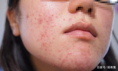 呈现黄红色油腻性白色鳞屑和痂皮;眉部及其周围有弥漫性红斑和脱屑