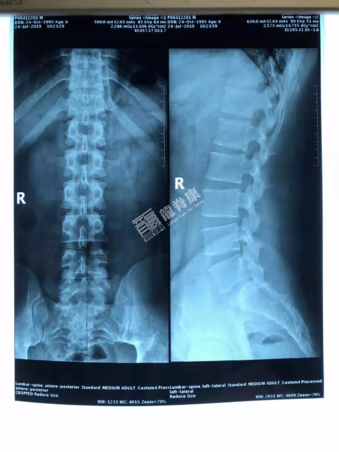 片子示:腰椎多棘突偏歪,l4/5椎间隙稍变窄,骶椎腰化,左横突与骶骨