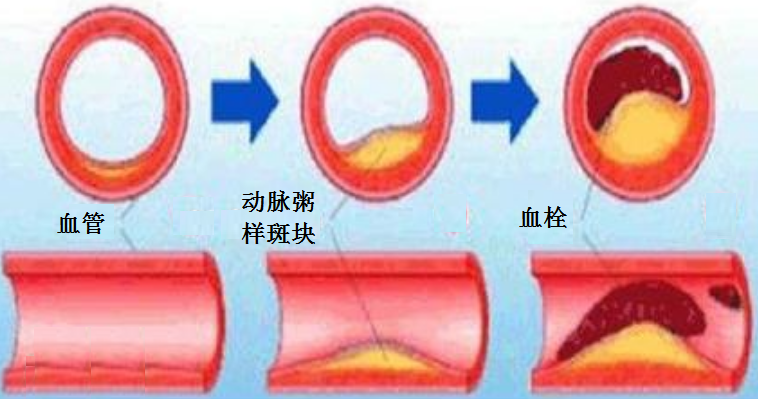 急性冠脉综合征-您需要了解的心脏急症—心内科专家黄宇科普系列