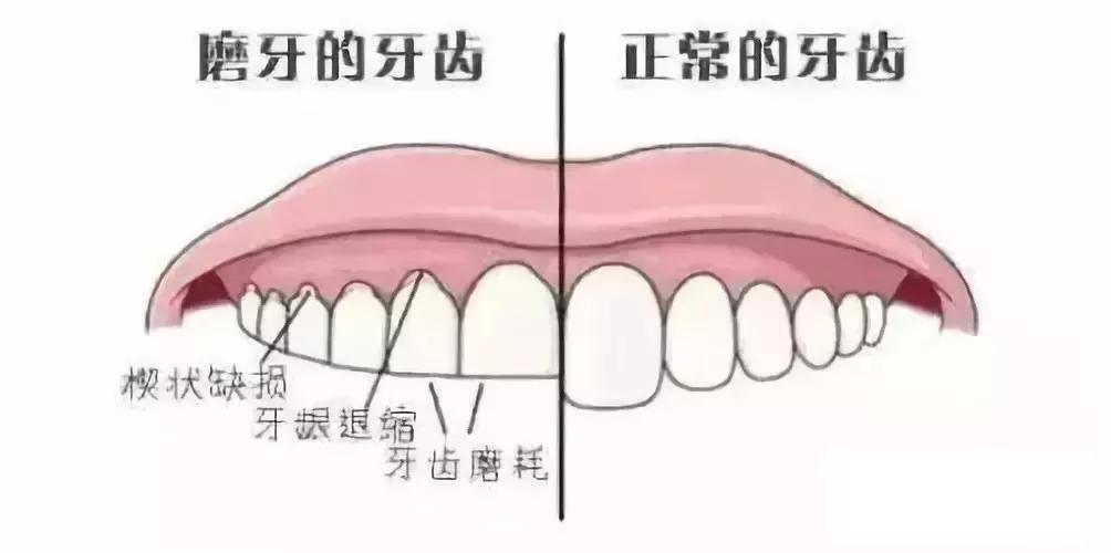[肥猪嘟嘟]为什么牙齿不齐的孩子越来越多？