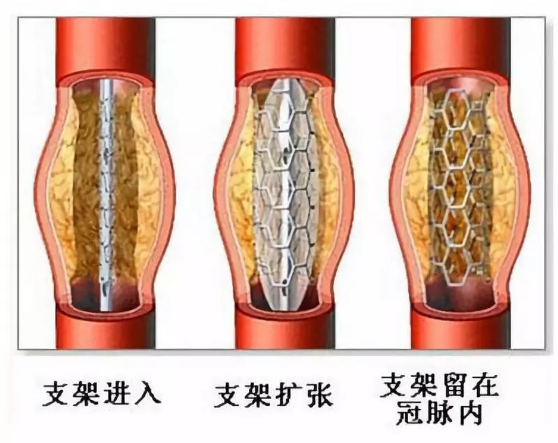 心脏支架
