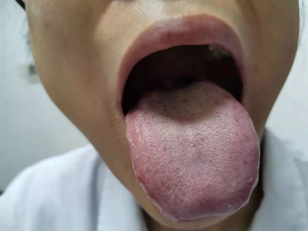 从舌诊察胃病