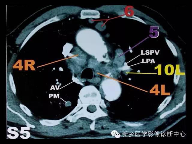 超赞总结纵膈淋巴结分区以及详细图解