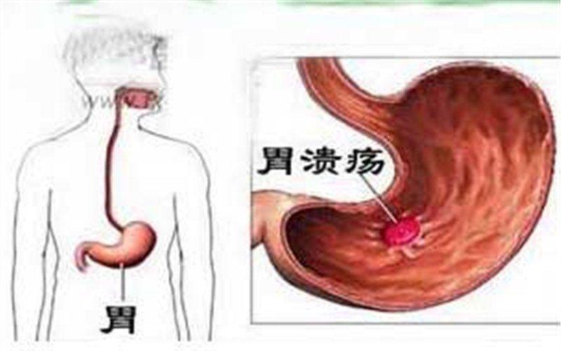 如果怀疑患有胃溃疡,请注意观察你的腹部疼痛症状.