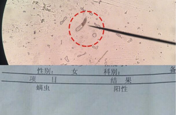 闭口人口_闭口粉刺图片(3)