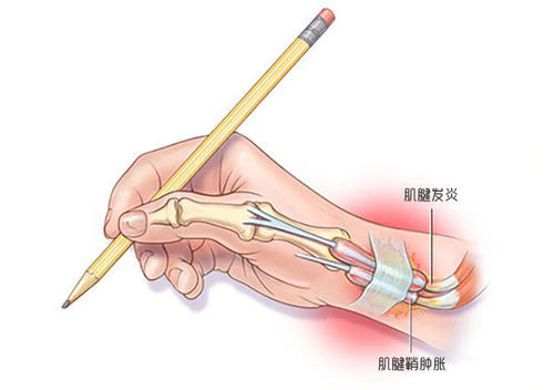 拇指腱鞘炎:学会这几招,轻松告别"妈妈手"