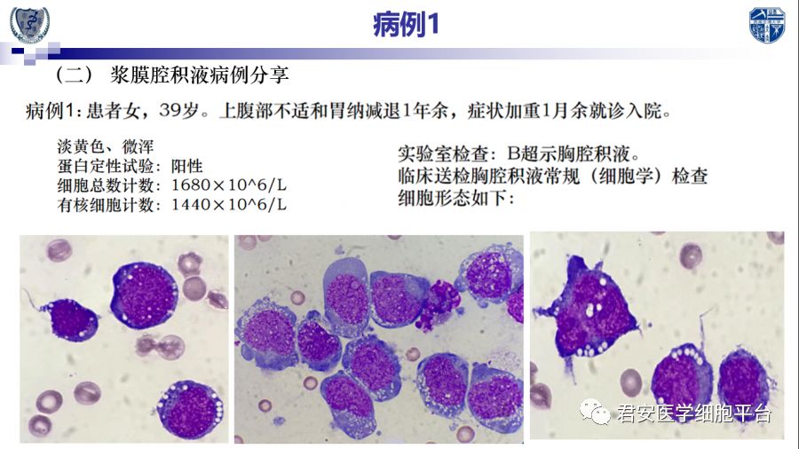 浆膜腔积液等常规形态学临床应用实践分享