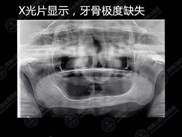 不用上颌窦提升技术,不植骨,不用长时间等待,实现半口,全口牙当天负重