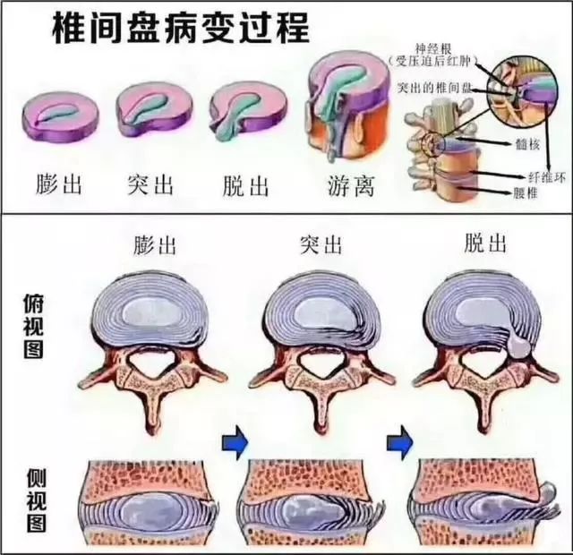 腰椎间盘膨出/突出/脱出…其实是腰椎间盘突出的不同程度的病理过程