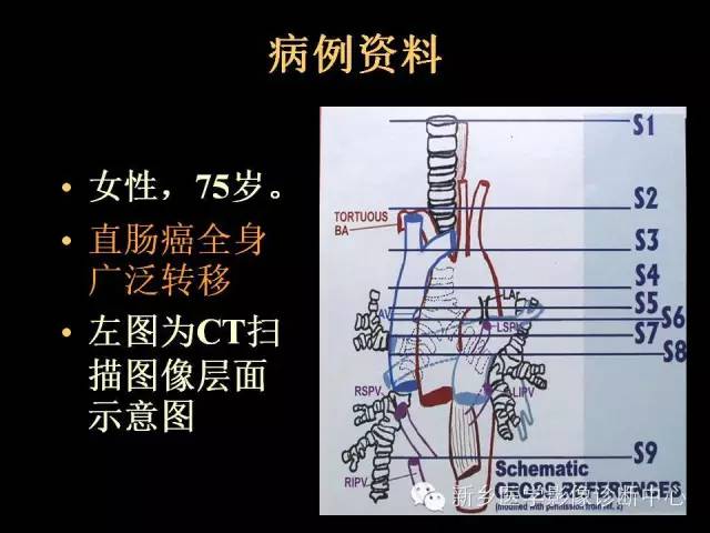 【超赞总结】纵膈淋巴结分区以及详细图解