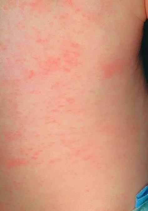孩子高发的8种皮肤病:风疹,湿疹,水痘,荨麻疹.一文全