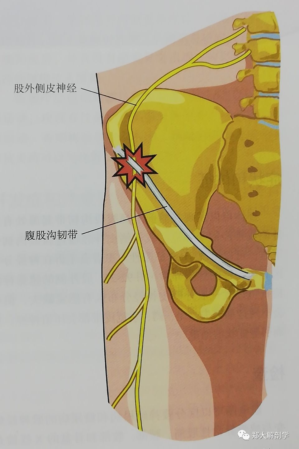 查体可以发现在髂前上棘腹股沟韧带起源处有股外侧皮神经的压痛点.