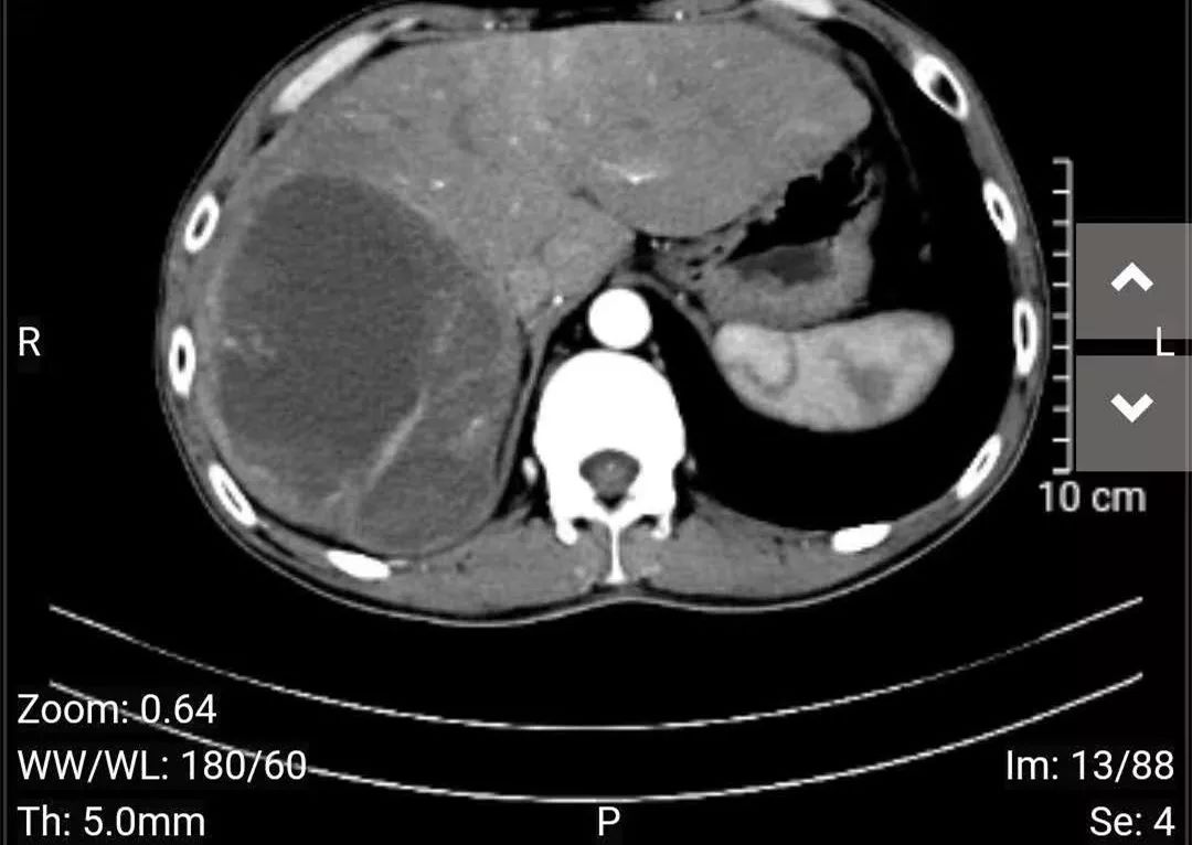 直径达约15cm,占据整个右肝叶,紧邻人体重要大血管,且有破裂的迹象