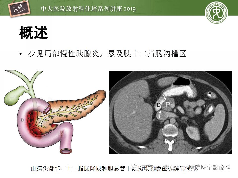 胰腺炎的影像评估