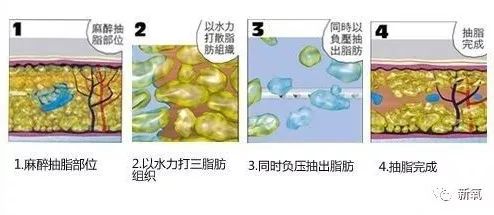 多少斤可以抽脂肪 23e2470f048a488ea368a0b1f70b259c.jpeg