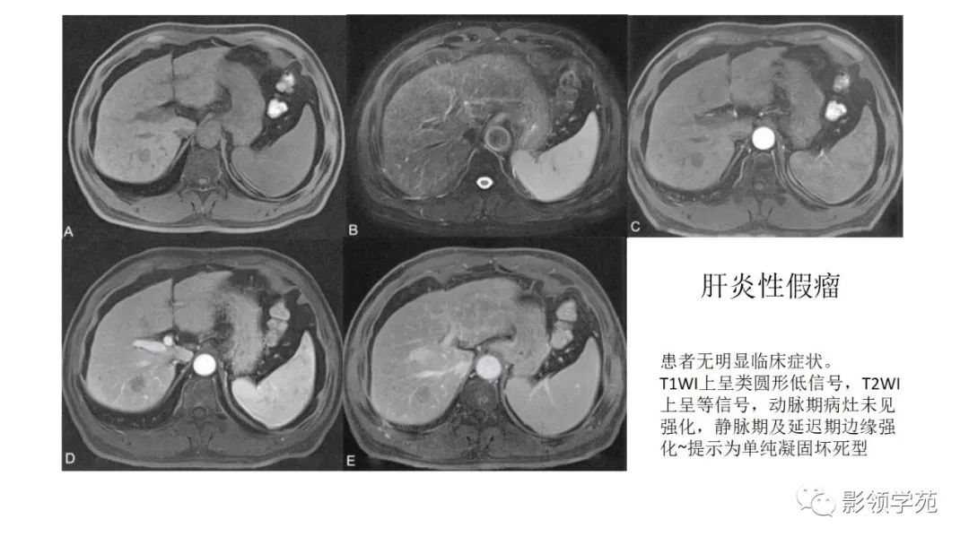 转移瘤渐进性强化:血管瘤,血管肉瘤,ehe,胆管癌,肝脓肿乏血供病变:肝