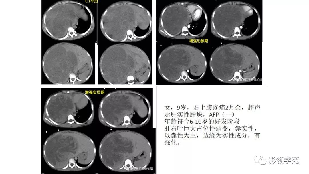 经典肝脏占位性疾病的分析思路