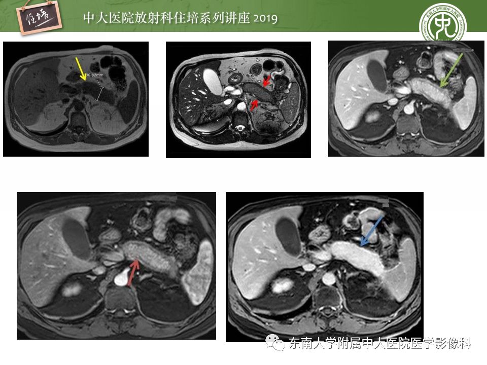 胰腺炎的影像评估