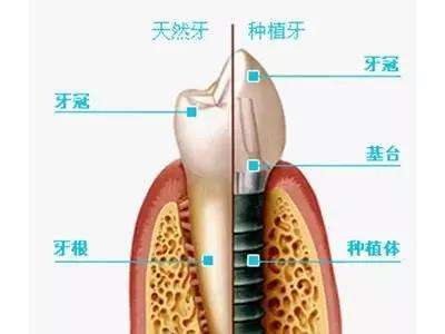 请问种植牙齿的根本技术原理是什么(3)