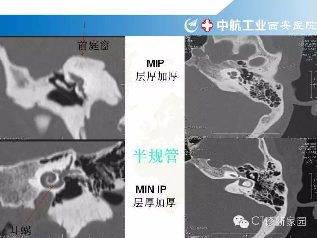 颞骨断层解剖及病例解读_蝶骨