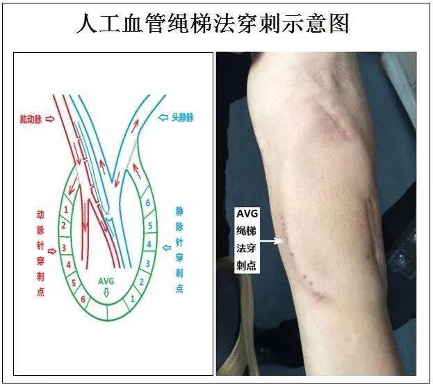 名院名医开讲了自体血管耗竭患者的生命线如何构建人工血管移植内瘘2