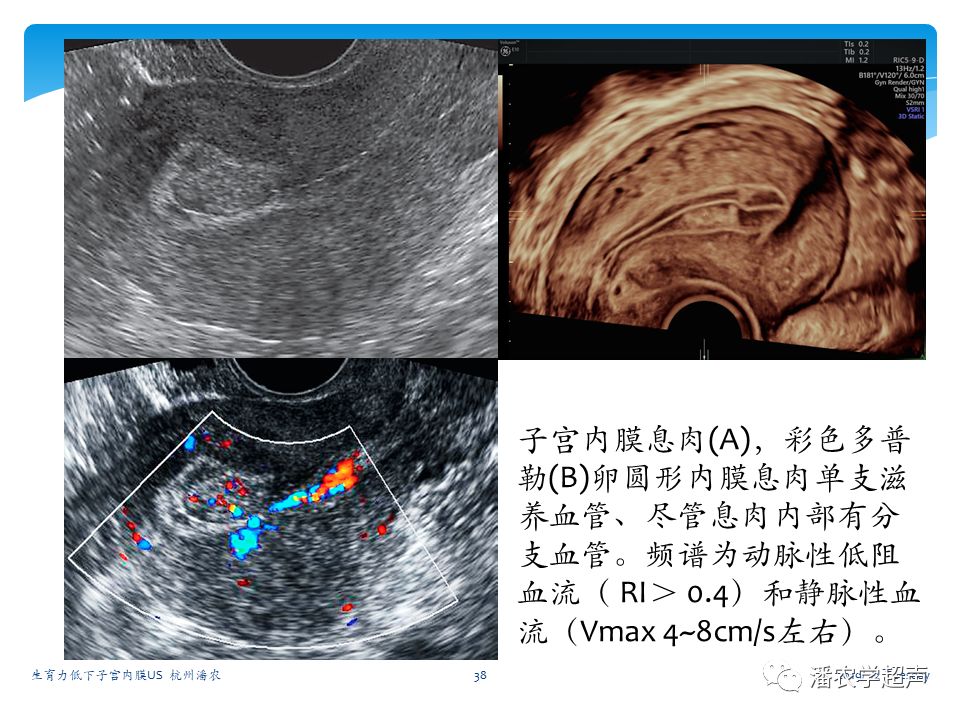 生育力低下子宫内膜常规超声评估
