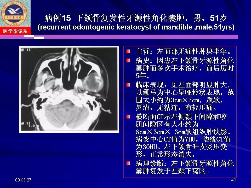 口腔颌面部囊肿肿瘤和肿瘤样病变的影像诊断丨影像天地