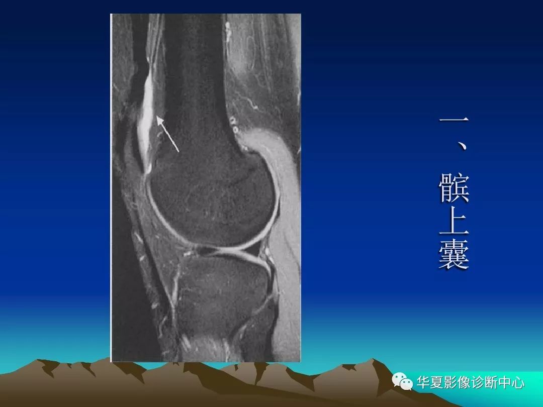 【影像基础】膝关节滑膜囊—影像图谱