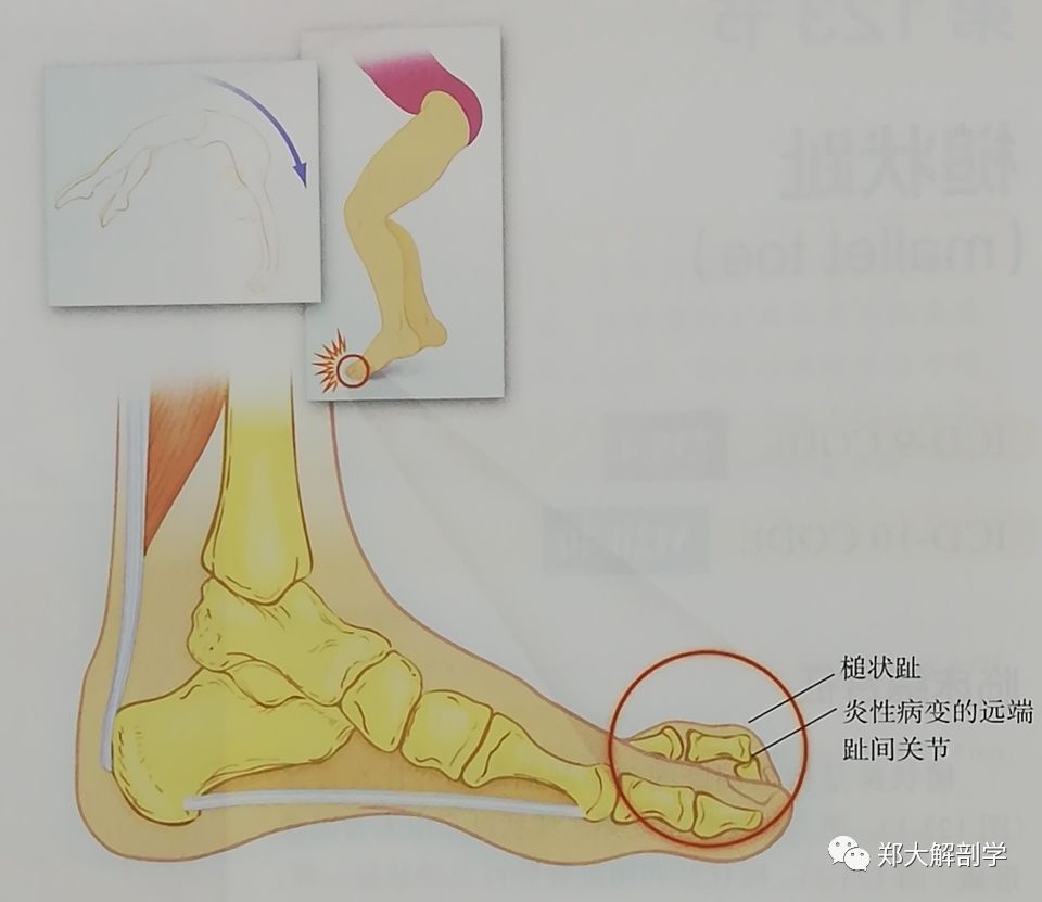 八种引起足部的疼痛综合征