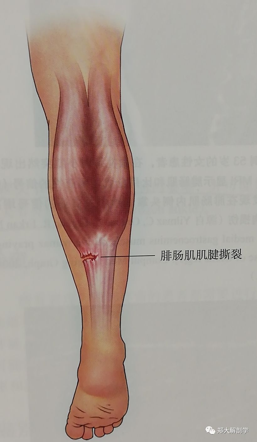 七种引起膝关节的疼痛综合征Ⅱ