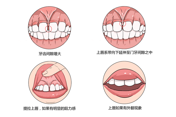 下唇系带断了怎么办