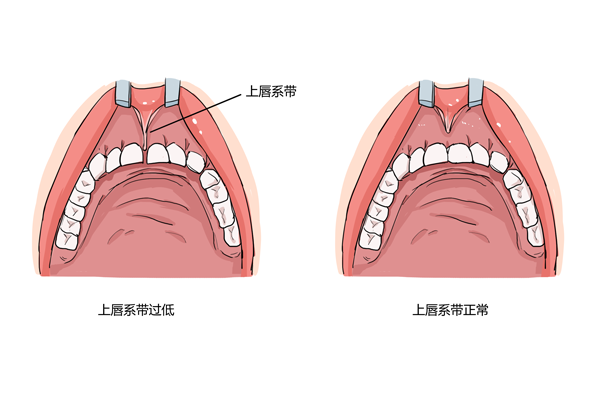 下唇系带断了怎么办