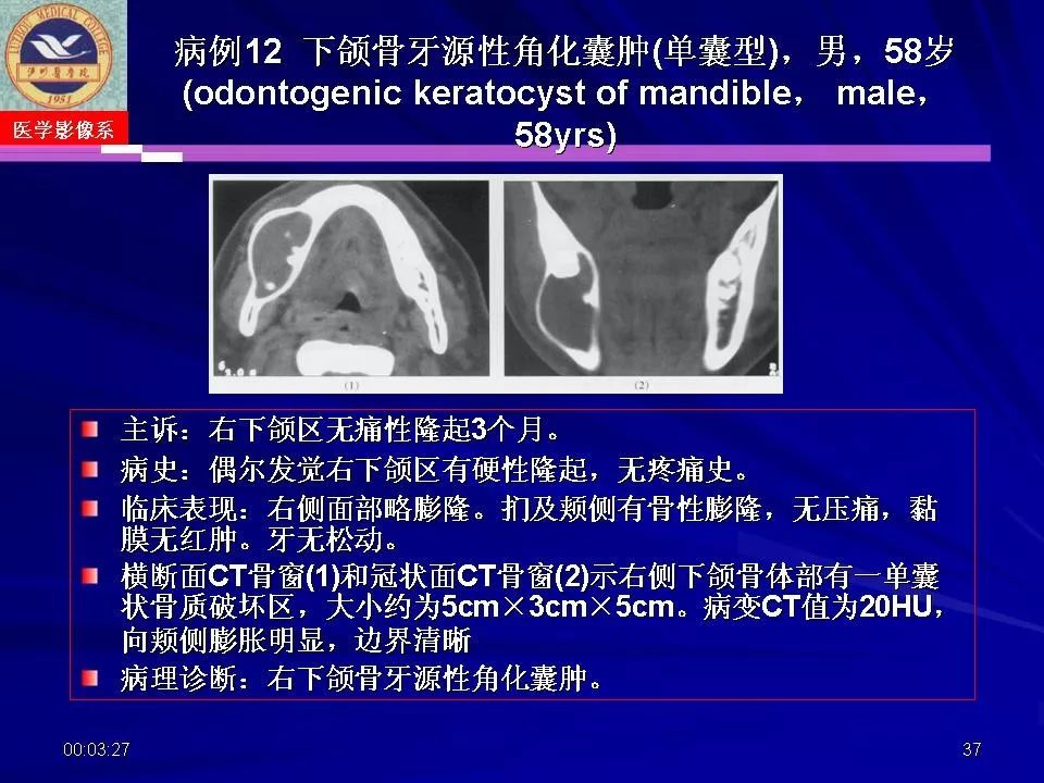 口腔颌面部囊肿肿瘤和肿瘤样病变的影像诊断丨影像天地