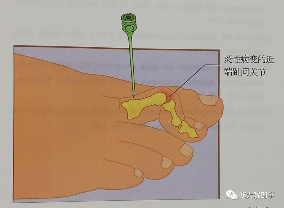 87趾囊肿是指在第一跖趾关节处的软组织肿胀,同时伴有第一跖趾关节