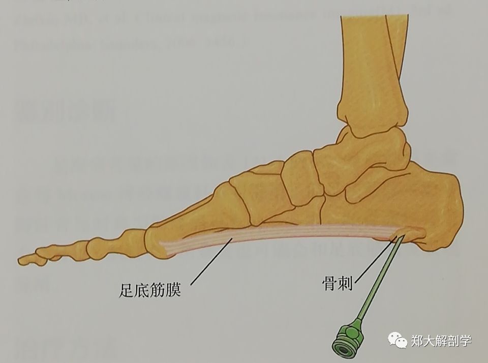 跟骨骨刺常无症状,引起疼痛是因为跟骨结节内侧足底筋膜附着处纤维炎